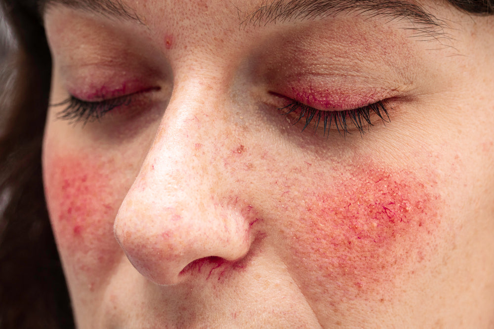 does glutathione help rosacea Rosacea Skincare Routine & Products To Use To Help Soothe and Ease Ros – The Greys Retreat