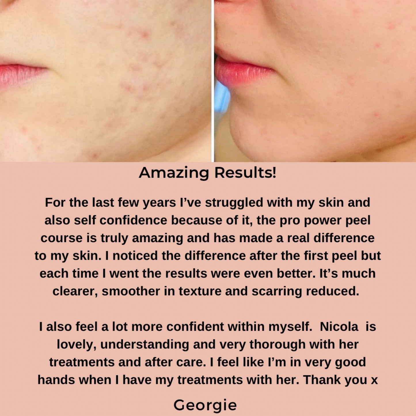 Pro Power Peel Treatment