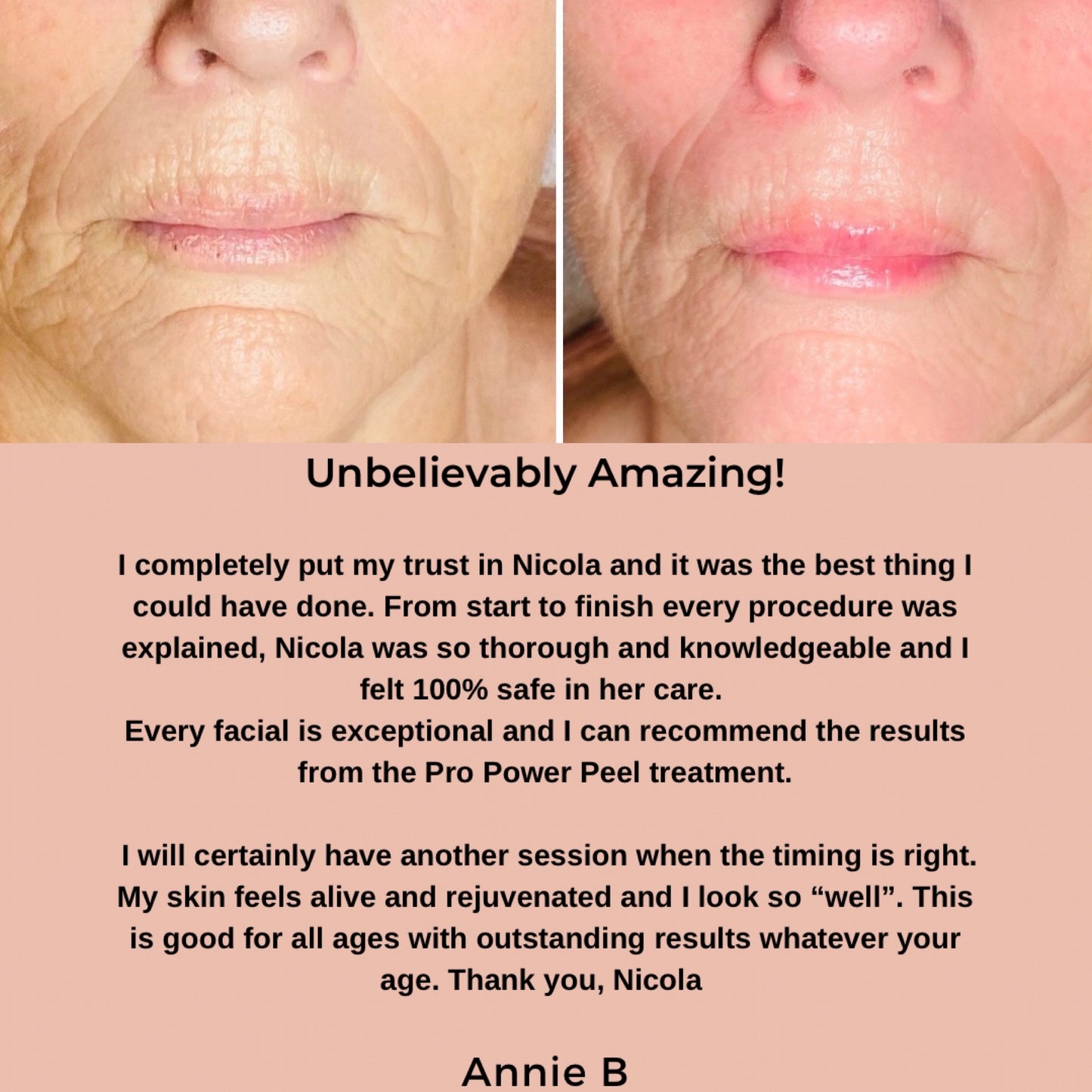 Pro Power Peel Treatment
