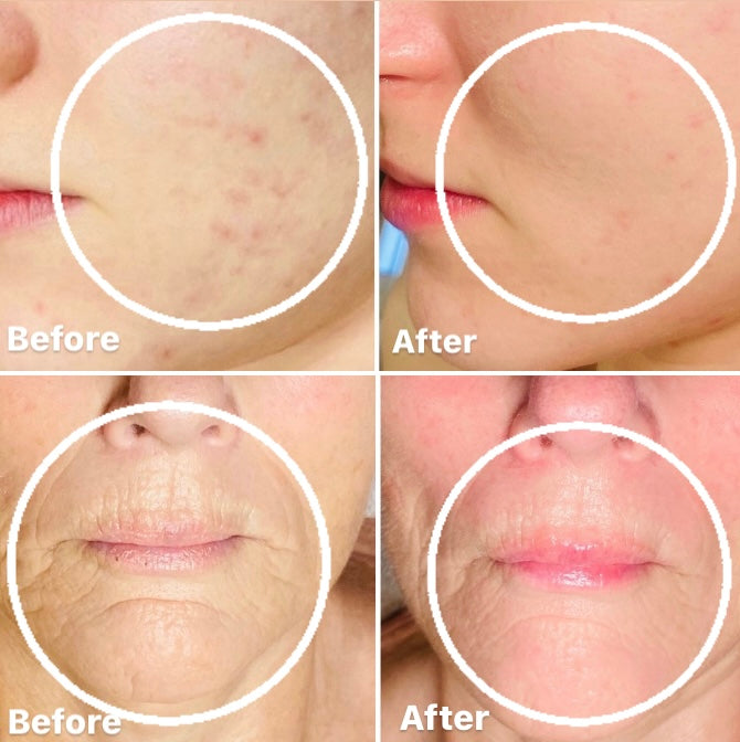 Pro Power Peel Treatment