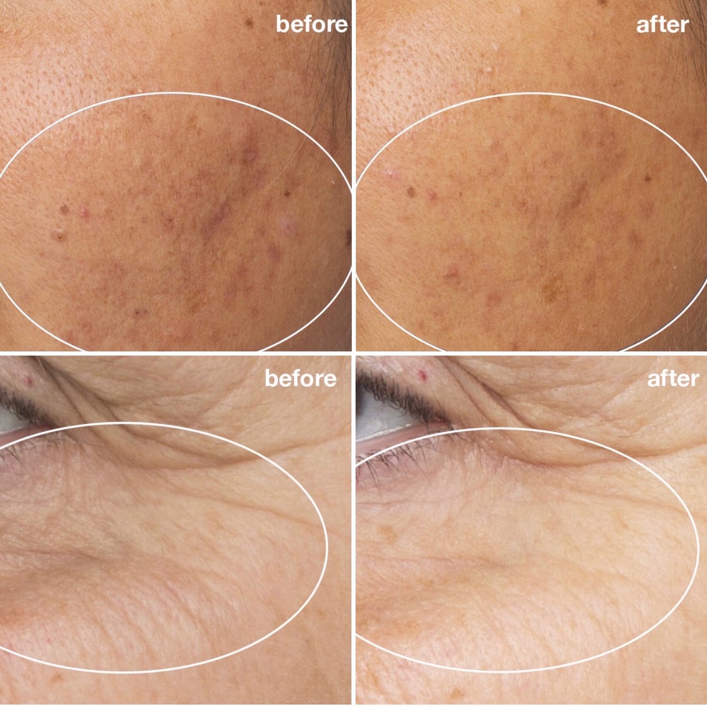 chemical peel before and after colchester