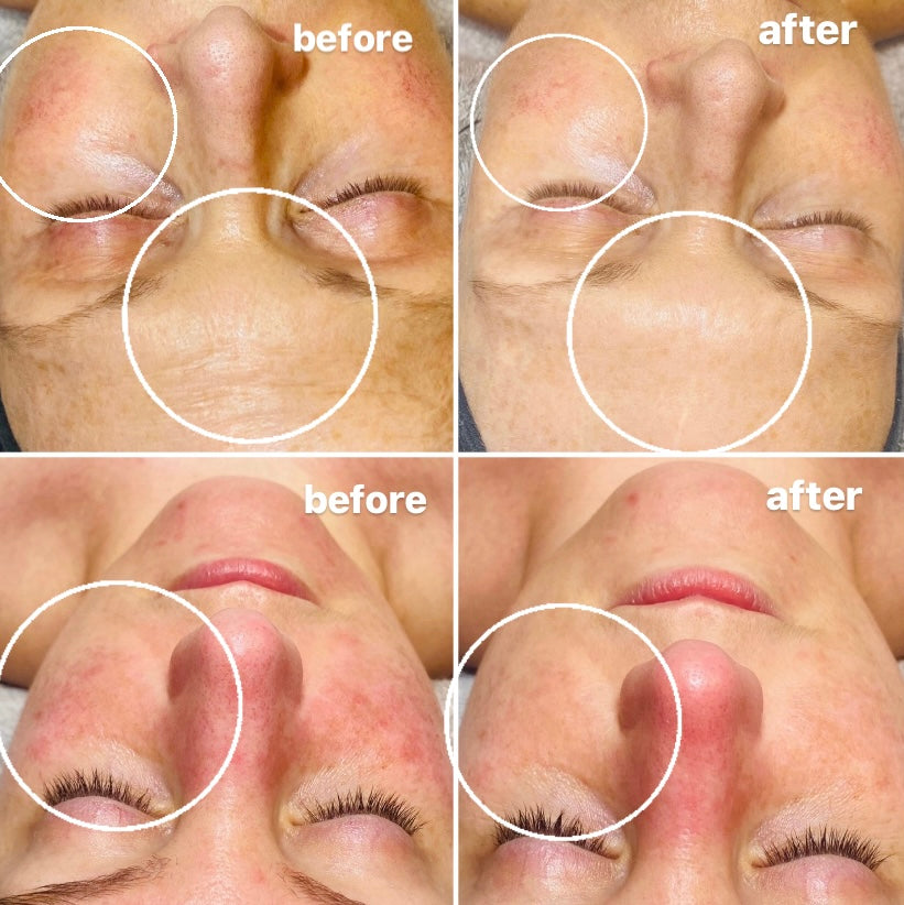 chemical peel in colchester