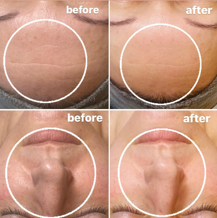 colchester chemical peel