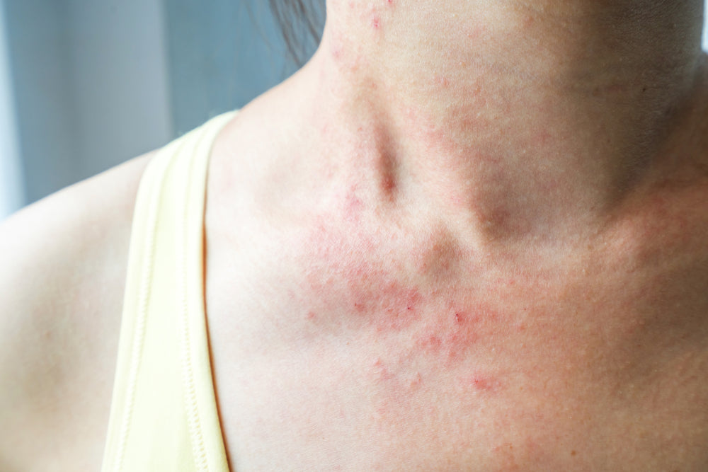 eczema skincare routine