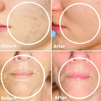 Pro Power Peel Treatment