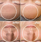 colchester chemical peel